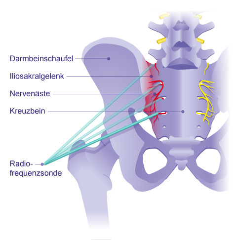 Thermokoagulation der Nerven am Iliosakralgelenk