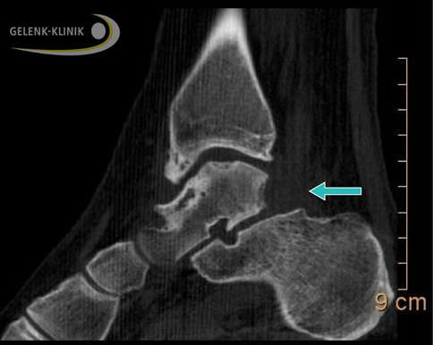 Das dorsale Sprunggelenk-Impingement ist nach der arthroskopischen Operation entfernt.