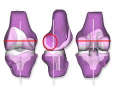 Individually matched knee prosthesis