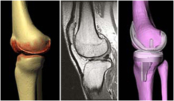 Größe, Stellung und Ausrichtung des Kniegelenks unterscheiden sich bei jedem Menschen. Knieprothesen können das berücksichtigen.