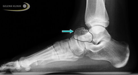 Röntgenbild eines Osteochondroms am Sprungbein (schwarz umrandet)