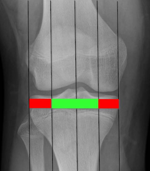 Röntgenbild: Einschätzung der Beinachsen