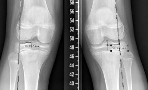 Röntgenbild eines 14-jährigen Jungen mit Genu valgum: Die mechanische Achsdeviation beträgt 26 mm beidseits. Die Wachstumsfugen sind noch offen. © Gelenk-Klinik mechanische Achsdeviation von 26 mm beidseits im Röntgenbild eines 14-jährigen Jungen