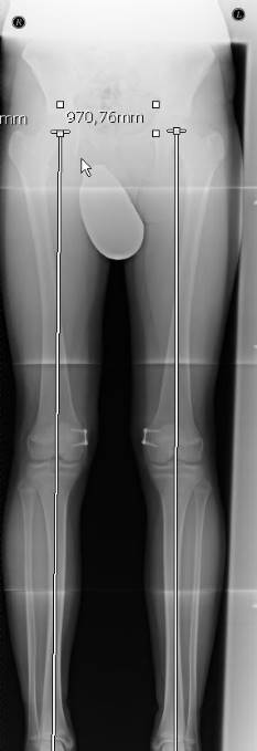 Röntgenbild: Die operative Korrektur hat zu einer Begradigung der Beinachsen geführt.