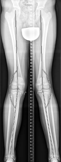 Röntgenbild einer Beinachsenfehlstellung (X-Bein) bei einem 14-jährigen Jungen