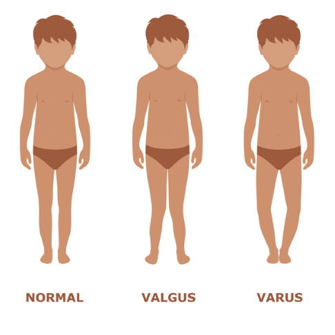 Beinachsenfehlstellungen: normale Beinachse, Valgusstellung, Varusstellung