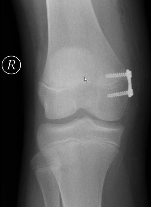 Röntgenbild einer operativen Korrektur einer Beinachsenfehlstellung mittels temporärer Hemiepiphysiodese