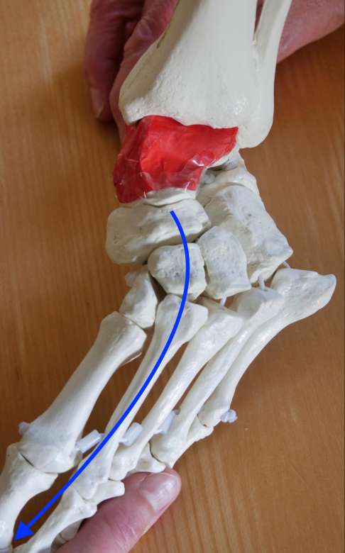 verschobene Fußknochen unterhalb des Sprungbeins