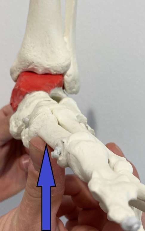1. Gipsverband: Über das Anheben des ersten Strahls wird die Hohlfußkomponente des Klumpfußes korrigiert. Das Sprungbein (Talus) ist rot dargestellt. © Gelenk-Klinik