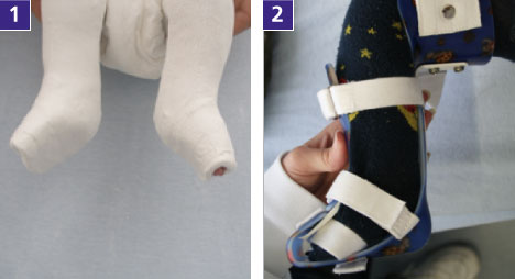 Ruhigstellung des Fußes mithilfe eines Oberschenkel-Unterschenkel-Fuß-Gipses nach peritalarer Arthrolyse. Im Anschluss an die Gipsbehandlung trägt das Kind noch etwa 6 Monate die Kopenhagener Nachtlagerungsschiene.