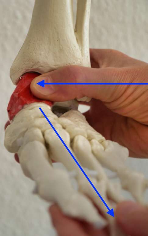 3. Gipsverband: Über Druck auf das Sprungbein (Talus, hier rot dargestellt) und Abspreizen des Fußes wird die Sichelfußkomponente des Klumpfußes korrigiert.