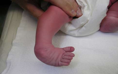Ein Kinderorthopäde stellt die Diagnose Klumpfuß bei einem fünf Tage alten Baby.