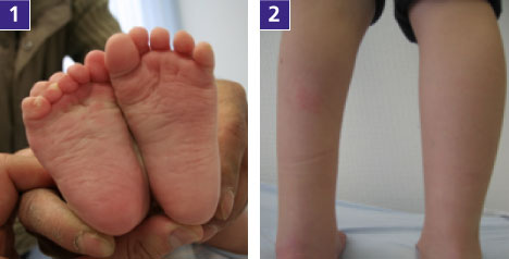 Kleinkind nach erfolgreicher Therapie eines einseitigen Klumpfußes: Gut sichtbar sind die unterschiedlich großen Füße und die etwas verkümmerte Wadenmuskulatur (Klumpfußwade). © Gelenk-Klinik. Ergebnis nach erfolgreicher Behandlung eines einseitigen Klumpfußes