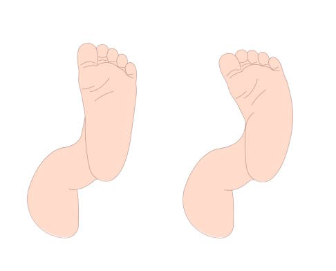 Vergleich normaler Fuß vs. Serpentinenfuß