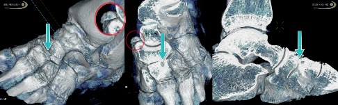 Sinus-tarsi Impingement bei Knick-Senkfuß