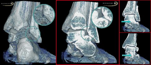 Ausgeprägte Fehlstellung Impingement und Arthrose bei Knick-Senkfuß im Endstadium