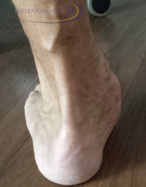 Knicksenkfuß im fortgeschrittenen Stadium von hinten
