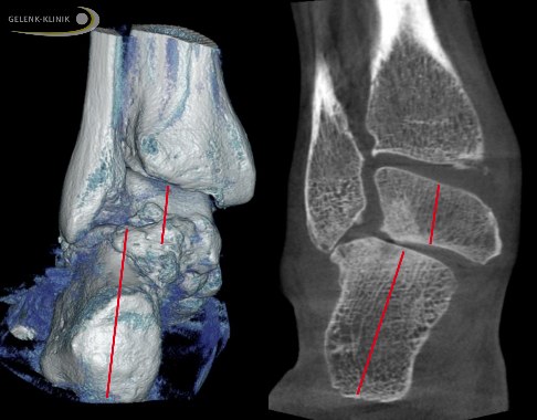 Knick-Senkuß mit Arthrose in einer DVT Aufnahme