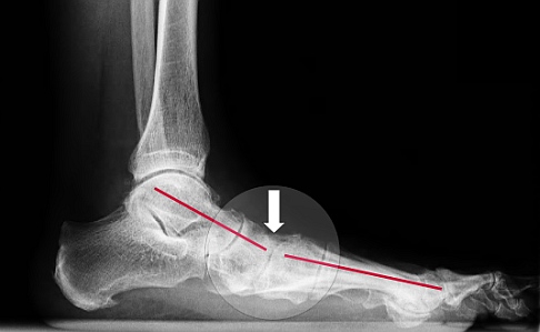 Плосковальгусная деформация в стопе: болезненное уплощение продольного свода стопы на рентгеновском снимке. 