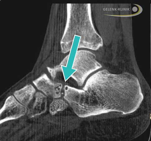 Fußknochen mit markierter talonavikulärer Koalition