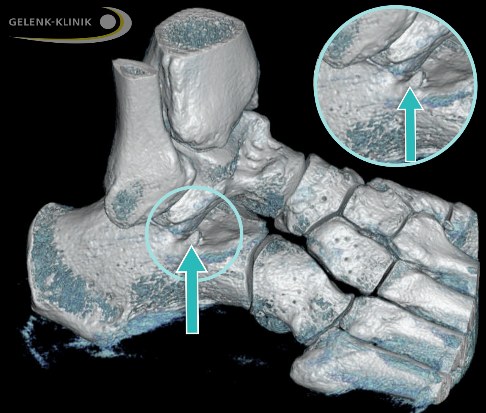 Sinus-tarsi Impingement bei Knick-Senkfuß