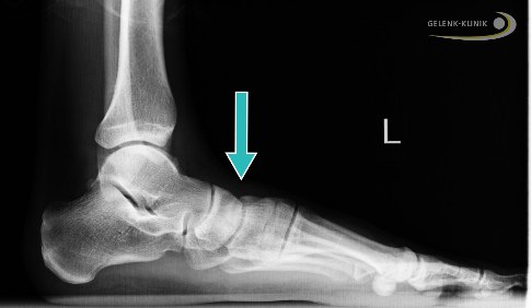 Tarsale Instabilität mit Absenkung des Tarsus im Frühstadium