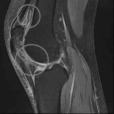 MRT: Knie mit Arthrofibrose