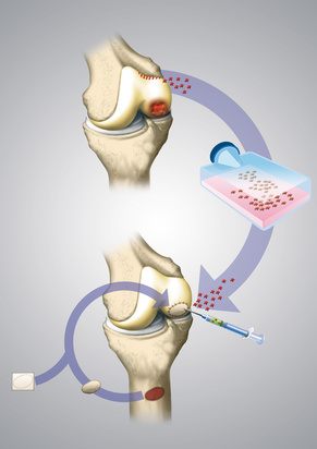 Ablauf einer autologen (körpereigenen) Knorpelzelltransplantation.