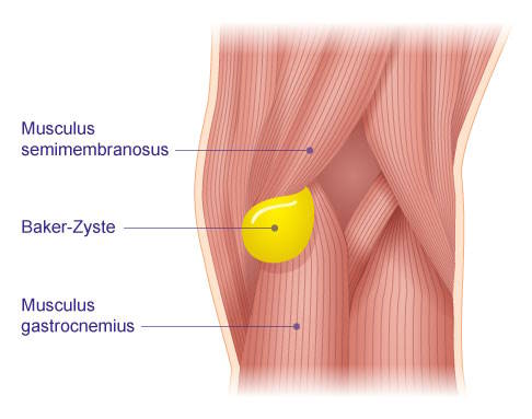 Kniegelenk von hinten mit Bakerzyste