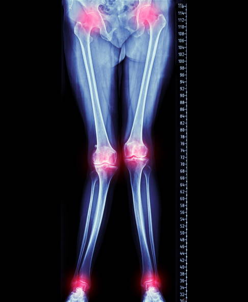 X-Bein im Röntgenbild