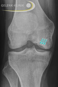 Röntgenbild: Knochendefekt nach Ablösung des Dissekats