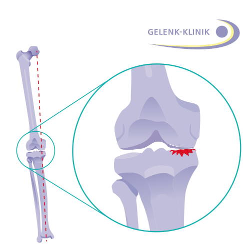 Schematische Darstellung des einseitigen Knorpelabriebs aufgrund von Kniegelenksarthrose und die daraus resultierende einseitige Verschmälerung des Gelenkspaltes