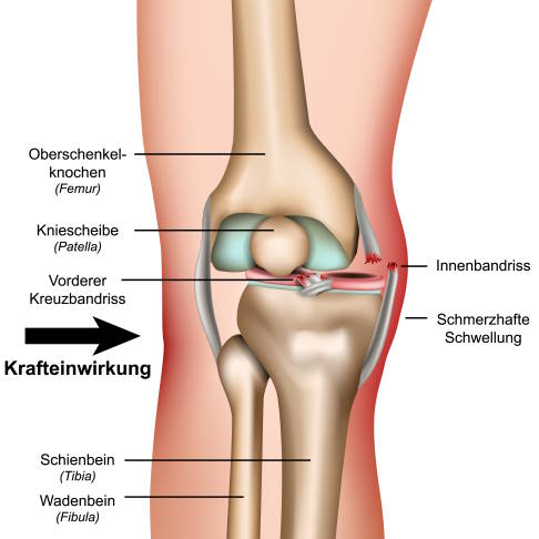 schwere Verletzung des Kniegelenks