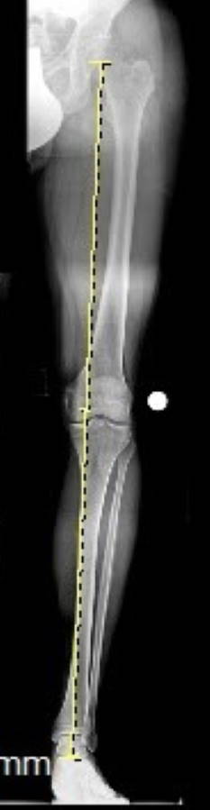 Röntgenbild eines leichten O-Beines mit medial (nach innen) verschobener mechanischer Beinachse