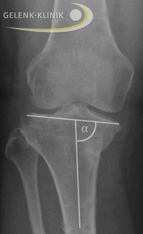 Darstellung einer O-Bein-Fehlstellung mit Belastungslinie im Röntgenbild beim stehenden Patienten