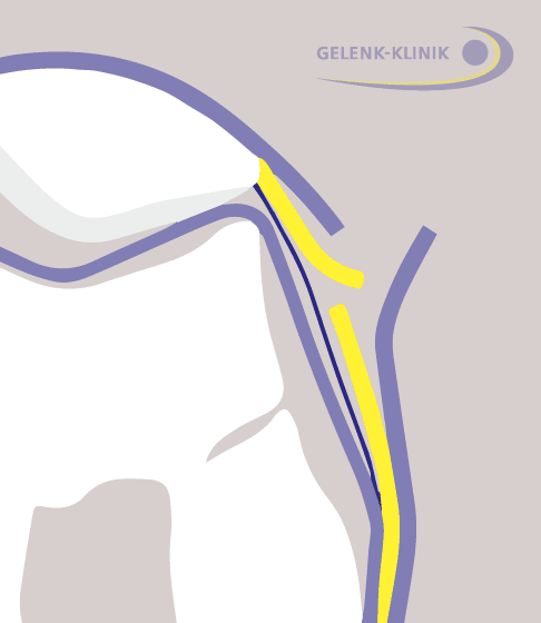 Im nächsten Schritt schneidet der Arzt die tiefe Schicht des Haltebandes (gelb) ein. © Gelenk-Klinik 2. Schritt der lateralen Retinakulumverlängerung