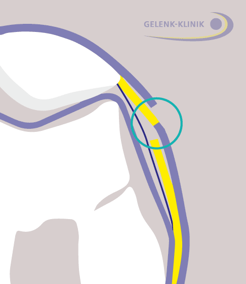 3. Schritt der lateralen Retinakulumverlängerung