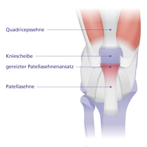 Das Patellaspitzensyndrom ist eine Erkrankung der Ansatzstelle der Patellasehne am Knochen. © Gelenk-Klinik Grafik Patellaspitzensyndrom