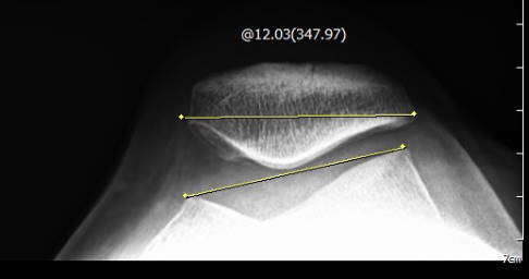 Kippstellung der Patella