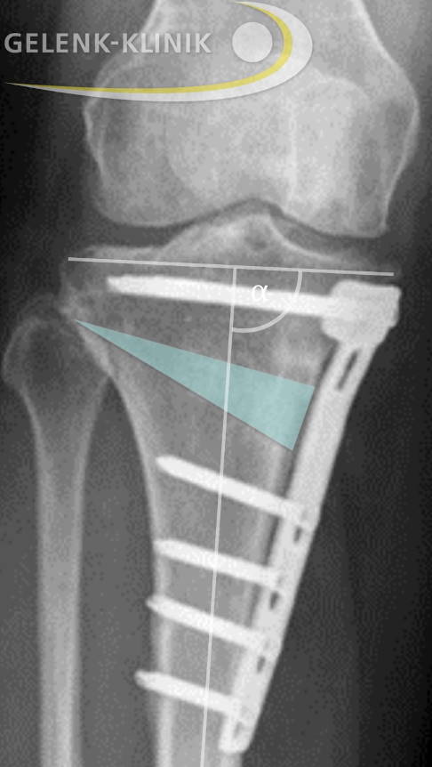 Röntgenbild eines stehenden Patienten nach Umstellungsosteotomie mit Belastungslinie