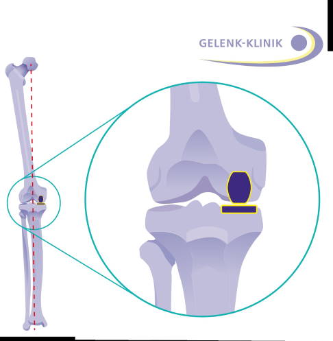 Teilgelenkersatz im Knie