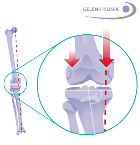 Warum kann eine Umstellungsosteotomie den Verschleiß im Kniegelenk verlangs...