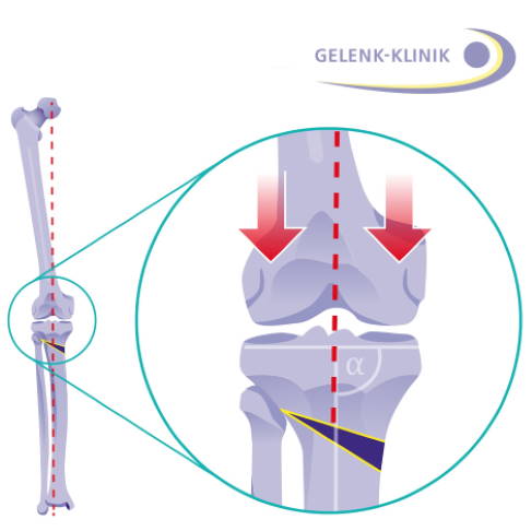 Корригирующая остеотомия исправляет деформации оси нижних конечностей и распределяет нагрузку на всю поверхность хряща. © Gelenk-Klinik