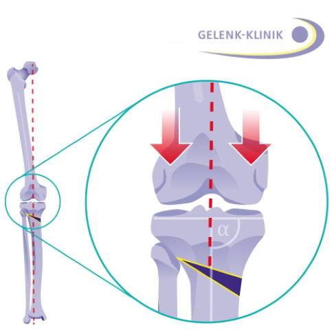 Kniegelenk nach Korrektur durch eine Umstellungsosteotomie