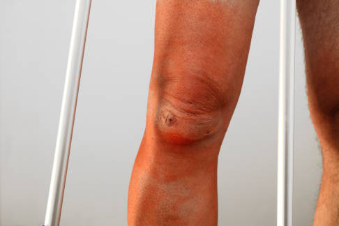 Wunde am Knie nach Arthroskopie
