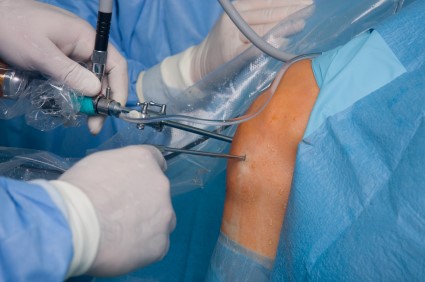 Bei der Kniearthroskopie führt der Orthopäde mit kleinsten Hautschnitten durch schmale Röhren medizinische Instrumente in das Knie ein.