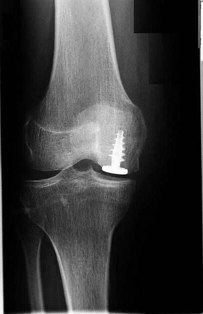Kniegelenk mit Osteonekrose, das durch ein Hemicap-System versorgt wurde