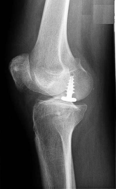 Die Oberflächenersatzprothese (Hemicap) kann kleine fokale (begrenzte) Knochen-Knorpelschäden (hier an der Oberschenkelrolle) versorgen und das Fortschreiten der Kniearthrose eindämmen.