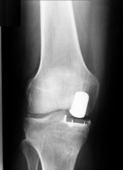 Рентген: Частичный эндопротез покрывает только медиальную (внутреннюю) часть коленного сустава. Здоровые элементы сустава остаются не поврежденными