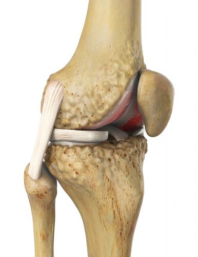 Retropatellare Arthrose oder patellofemorale Arthrose